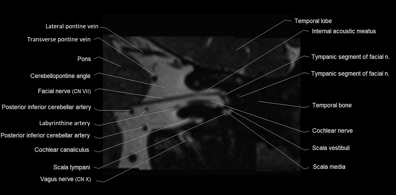 Internal auditory meatus (IAM) axial cross sectional anatomy image 11.webp